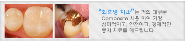 최효영 치과는 거의 대부분 Composite 사용 하여 가장 심미적이고, 안전하고, 경제적인 충치 치료를 해드립니다